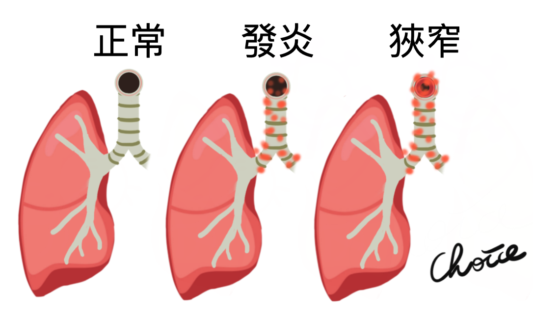 Progression of bronchospasm.